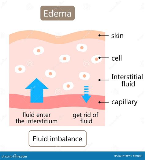 Diagram Of Edema Illustration Skin Swelling Is Caused By Excess Fluid