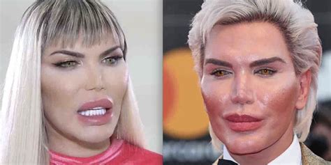 Human Ken Doll — Who Spent More Than 600000 On Over 70 Surgeries To