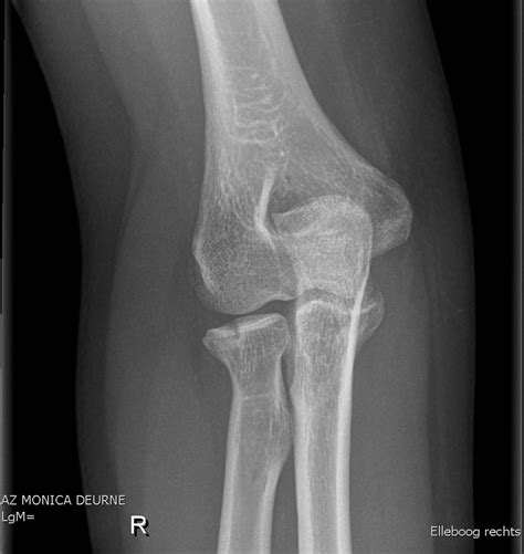 My Approach To Radial Head Fractures The Clinical Advisor