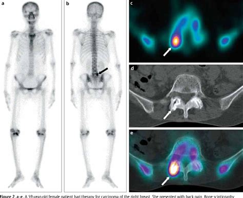 Figure From Hybrid Spect Ct For Characterizing Isolated Vertebral