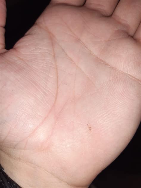 I Have Had These Black Dots On The Palm Of My Hand For A Few Weeks