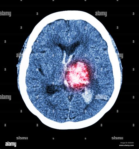 Cerebro Tac Muestran Hemorragia Talámico Izquierdo Accidente