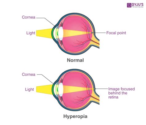 Hypermetropia Far Sightedness Symptoms Causes Types And Treatment