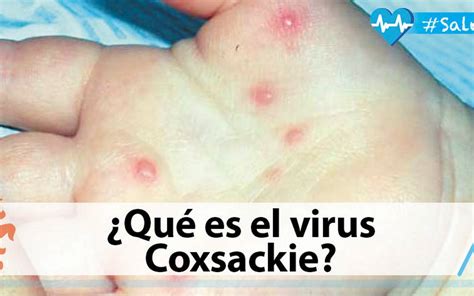 ¿qué Es El Virus Coxsackie El Sol De Tampico Noticias Locales Policiacas Sobre México