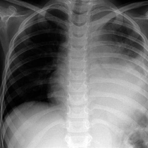 Preoperative Chest X Ray Showing Massive Pleural Fluid Download