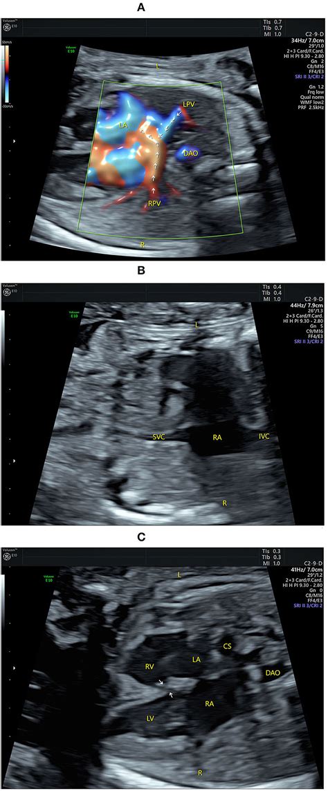 Frontiers Prenatal Diagnosis Of Pulmonary Atresia With Ventricular Septal Defect And An