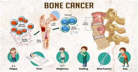 Bone Cancer Symptoms Causes And Treatment Health Reactive Body Revival