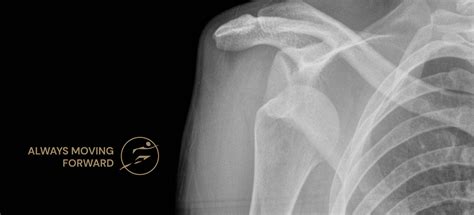 Recurrent Dislocation Shoulder Dislocation Surgery Arthros Clinic