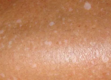 White Spots On Skin White Spots On Face Dots Patches Small