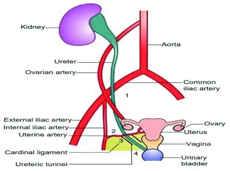 Various Points At Which Ureter Is Prone To Injury In Gynaecological