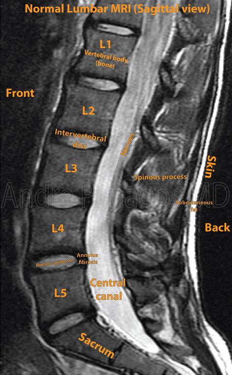 Mri Lumbar Spine Sagittal Cross Sectional Anatomy Anatomy Images Mri The Best Porn Website