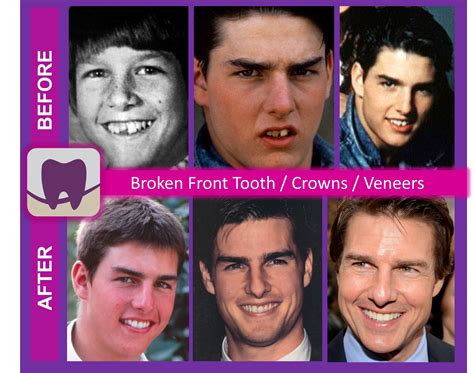 Celebrity Smiles Revealed Tom Cruise Stouffville Smiles Dentistry