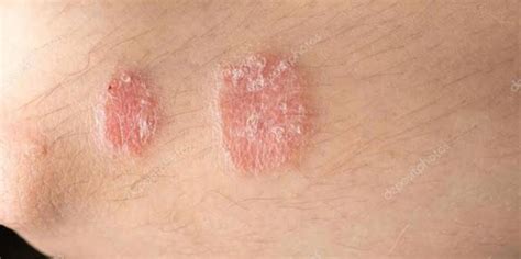 Cutaneous Eruption Vücutta Nasıl Görünür Güncel Bilgiler 2023