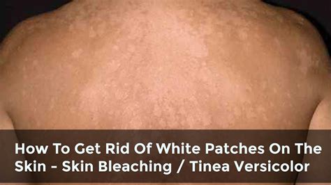 How To Get Rid Of White Patches On The Skin Skin Bleaching Spots