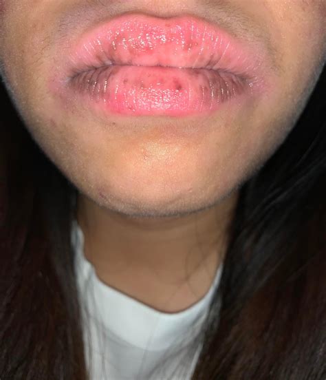 Why Is There Black Patches And Spot On My Lips And How Do I Get Rid Of Them Rdermatology