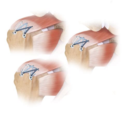 Arthrex Fibertak Speedbridge Rotator Cuff Repair