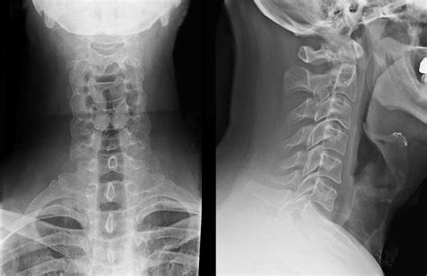 Cervical Spine Radiographs In The Trauma Patient