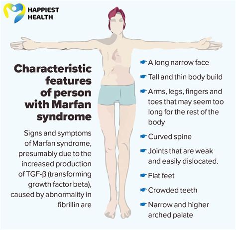 Marfan Syndrome Cause And Diagnosis Happiest Health