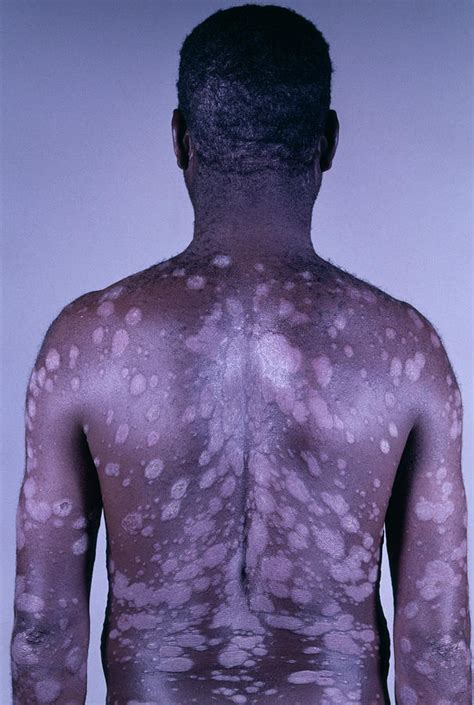 Aids Man With Psoriasis Photograph By Dr Ma Ansaryscience Photo