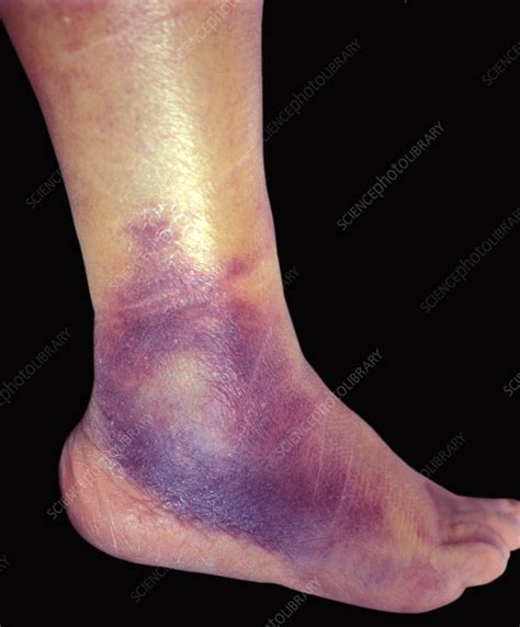 Bruised Ankle Stock Image C0515011 Science Photo Library