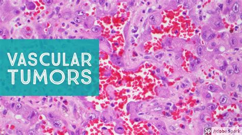 Vascular Tumors Of The Skin Explained By A Soft Tissue Pathologist
