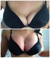 New Breast Lift Technology Photos