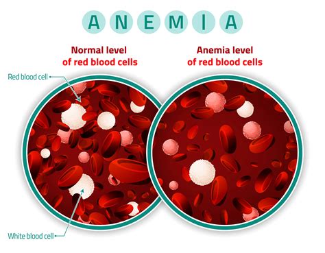 Anemia In Children Symptoms Causes And Treatment Options Activebeat