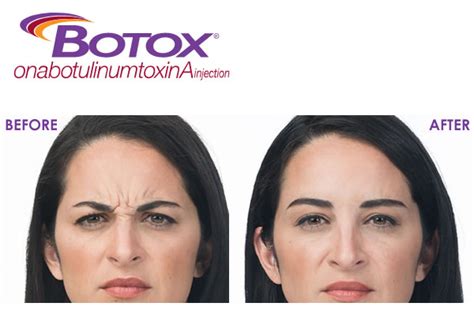 Botox In Portland Or Style Aesthetics By Rajanimd