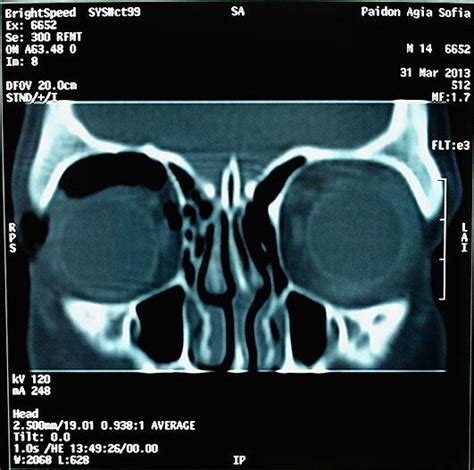 Coronal Ct Scan Disruption Of The Right Lamina Papyracea Presence Of