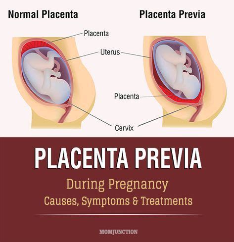 Placenta previa management is a tricky and highly debated topic. chorionic villus | chorionic villi | Everything ...