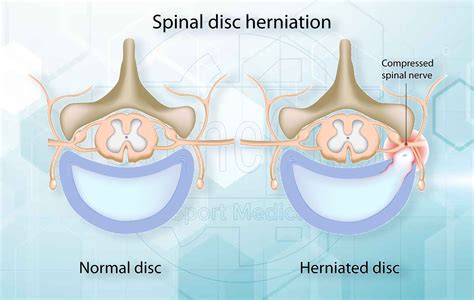 Herniated Disc Bulging Disc Slipped Disc Whats The Difference