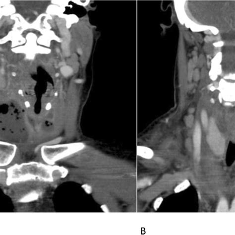 Cect Coronal Image Inferior Extension Of The Deep Neck Abscess