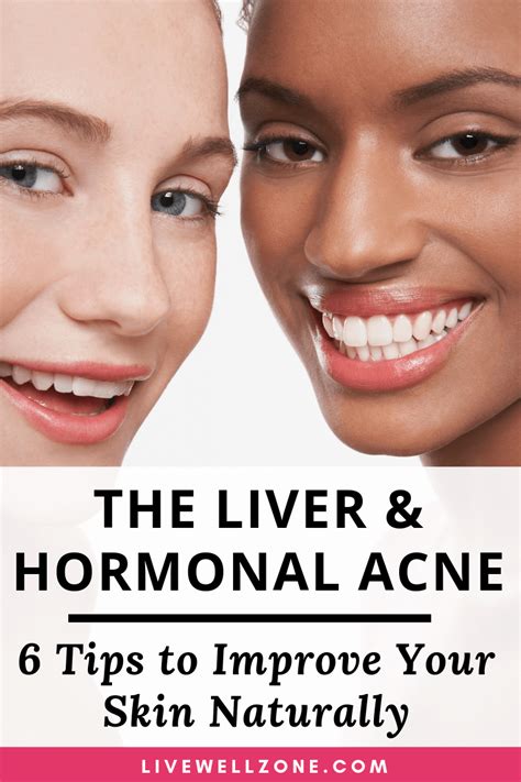 Liver And Hormonal Acne 6 Tips To Improve Your Skin Naturally Hormonal
