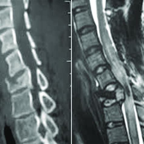 A Ct Scan Cervical Spine Showing Compression Fracture C7 Vertebral