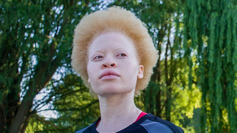 Albino Black People Telegraph