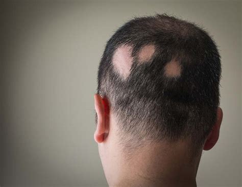 Keep reading to see what i found about black hair thinning at crown. Black Hair Thinning At Crown | Best Hairstyles 2018