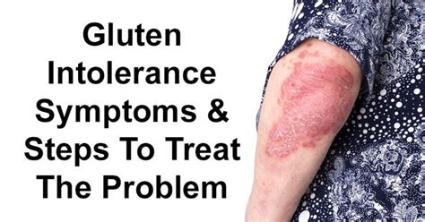 Gluten Intolerance Or Nsgs Is Different From Celiac Disease And Is