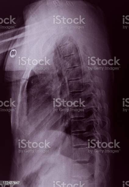 Chest Xray Image Stock Photo Download Image Now Anatomy Bronchial
