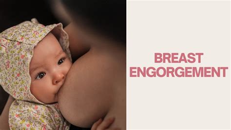 Breast Engorgement Breastfeeding Vlogs Breast Engorgement Management Youtube