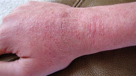 Itchy Skin Caused By Kidney Disease Kidkads