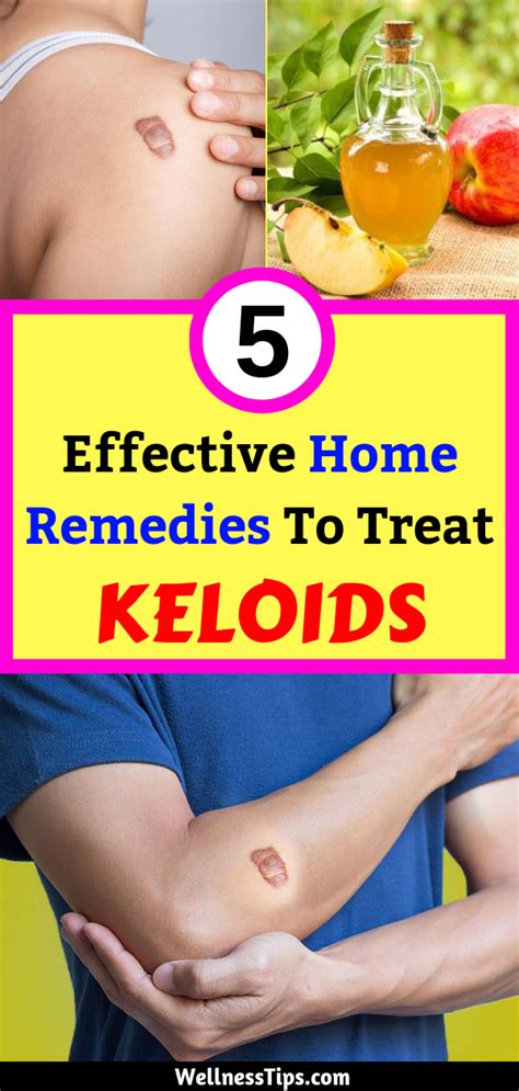 5 Effective Home Remedies To Treat Keloids Home Remedies Remedies Face Health