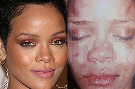 rihanna s battered face leaked picture shows injuries after alleged assault by chris brown