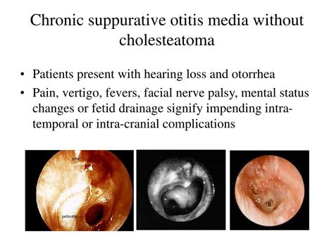 Chronic Suppurative Otitis Media With Cholesteatoma