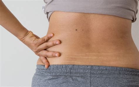 Methods To Minimize The Appearance Of Stretch Marks