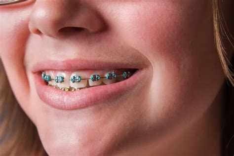How Much Do Braces Cost For Overbite And Buck Teeth Jacanswers
