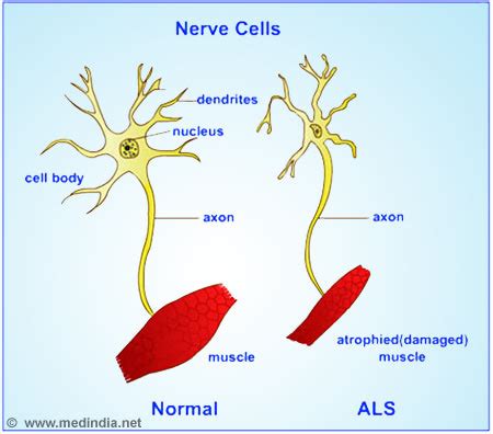 What is amyotrophic lateral sclerosis? Amyotrophic Lateral Sclerosis (ALS)-Lou Gehrig's disease: Symptoms, Diagnosis, Treatment