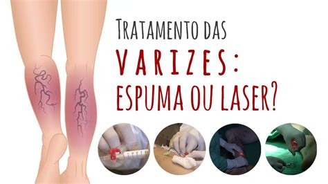 Tratamento Das Varizes Espuma Ou Laser YouTube