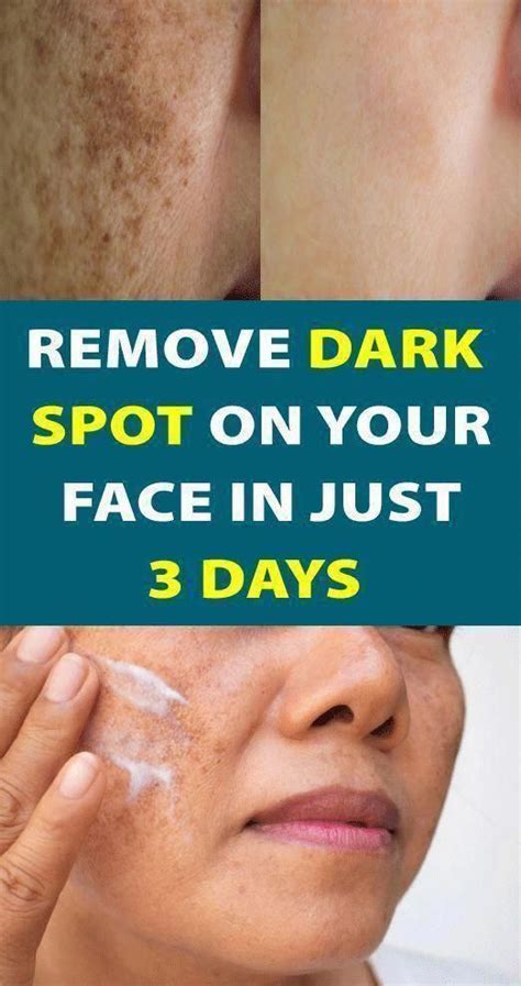 Ways To Get Rid Of Brown Spots On Encounter Brownspotsremoval
