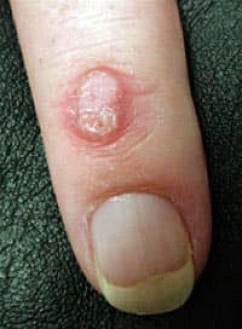 Medical Advice About Myths And Treatment For Warts Cbc News