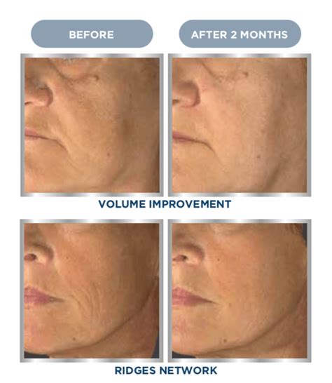 Sunekos Injectable Treatments Lincoln Laser Skin Care